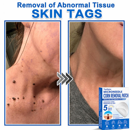 ✨TopSpire® 2-in-1 Microneedle & Hydrocolloid Patch | Targeted Solution for Raised Moles, Acne, Flat Warts & Skin Tags | Helps Improve the Appearance of Fine Lines, Scars & Skin Imperfections | Invisible Star Pimple Patches for Face & Body