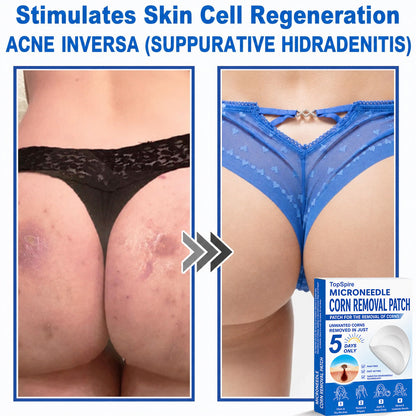 ✨TopSpire® 2-in-1 Microneedle & Hydrocolloid Patch | Targeted Solution for Raised Moles, Acne, Flat Warts & Skin Tags | Helps Improve the Appearance of Fine Lines, Scars & Skin Imperfections | Invisible Star Pimple Patches for Face & Body