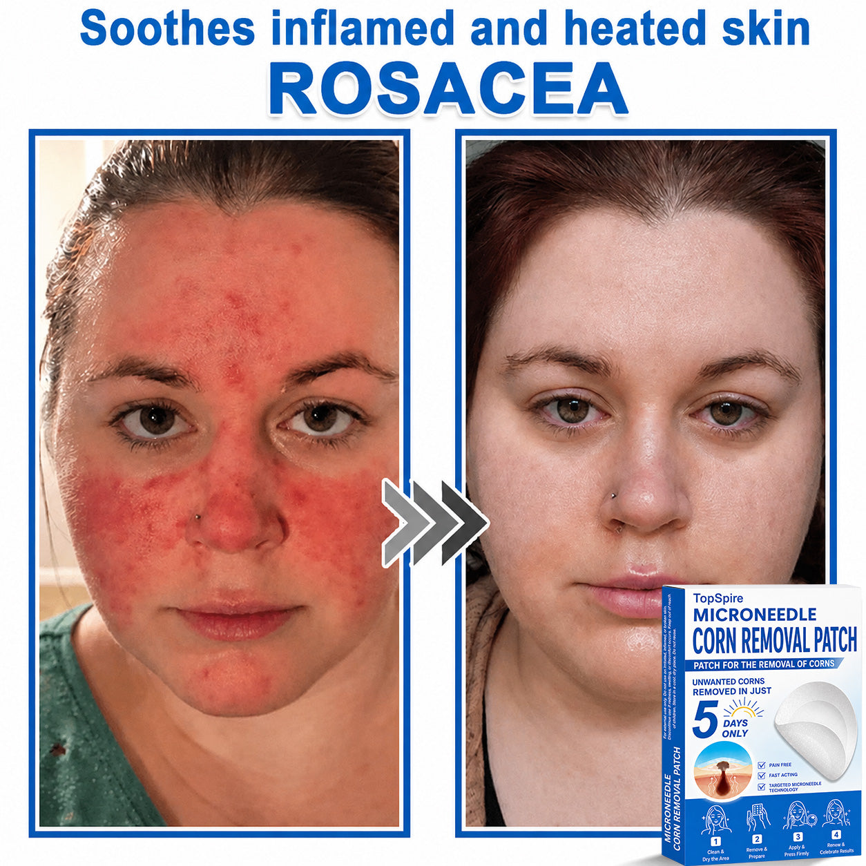 ✨TopSpire® 2-in-1 Microneedle & Hydrocolloid Patch | Targeted Solution for Raised Moles, Acne, Flat Warts & Skin Tags | Helps Improve the Appearance of Fine Lines, Scars & Skin Imperfections | Invisible Star Pimple Patches for Face & Body