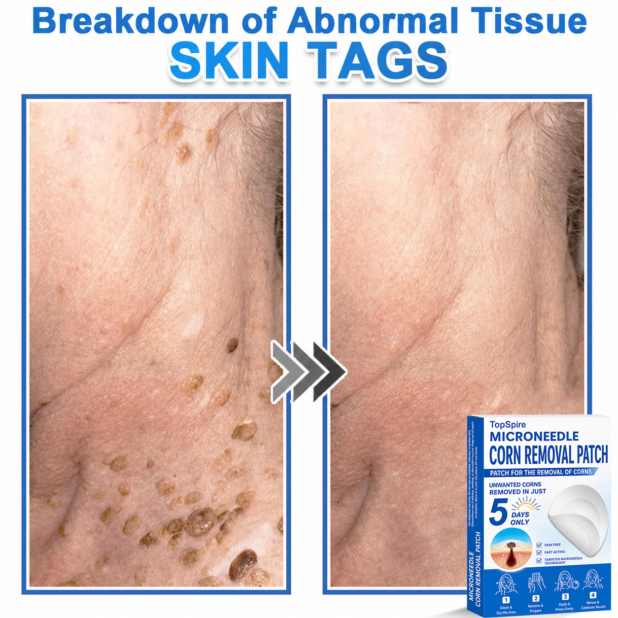 ✨TopSpire® 2-in-1 Microneedle & Hydrocolloid Patch | Targeted Solution for Raised Moles, Acne, Flat Warts & Skin Tags | Helps Improve the Appearance of Fine Lines, Scars & Skin Imperfections | Invisible Star Pimple Patches for Face & Body