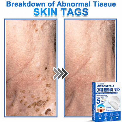 ✨TopSpire® 2-in-1 Microneedle & Hydrocolloid Patch | Targeted Solution for Raised Moles, Acne, Flat Warts & Skin Tags | Helps Improve the Appearance of Fine Lines, Scars & Skin Imperfections | Invisible Star Pimple Patches for Face & Body